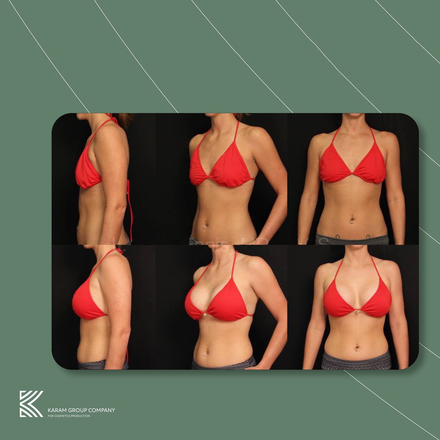 Breast tightening and shaping kit - Lydicca 